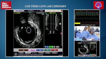 Stent Surgery For A Bifurcation Lesion | Dr. Sharat Chandra & Dr. AB Mehta | CSI kochi |
