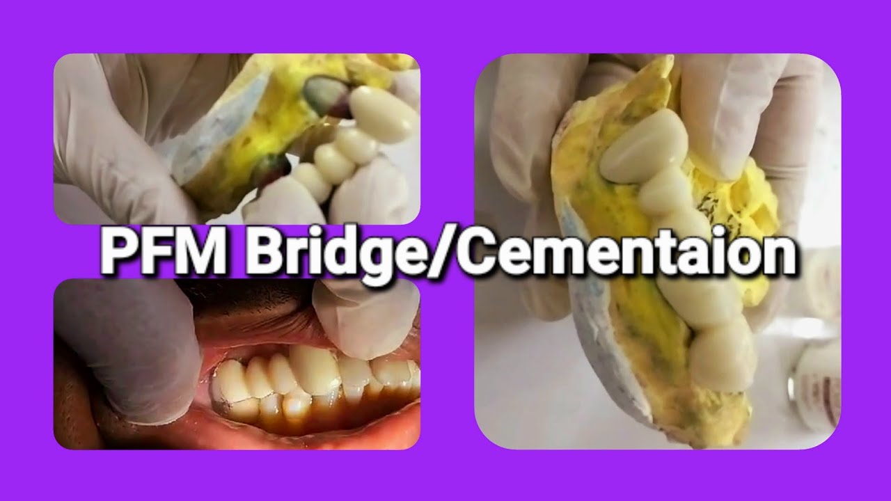 Dental Prosthesis Dental Bridge Artificial teeth YouTube