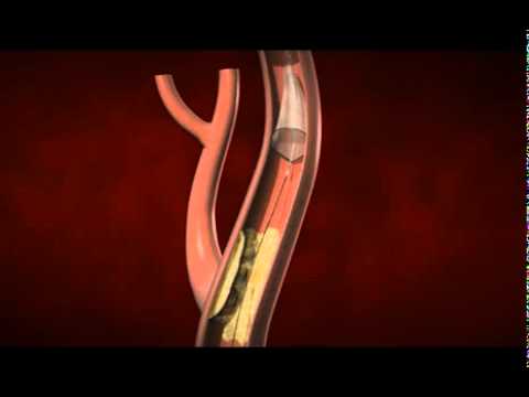 drohne Carotid Stenting and Endarterectomy