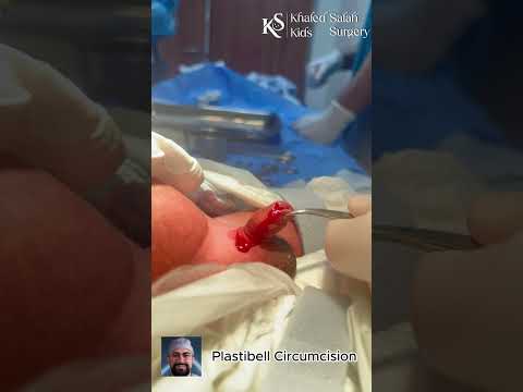Plastibell Circumcision