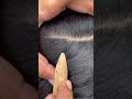 #fypviralシ #statisfying #lice #hair #LiceOnHead #liceremoval  #brasil #xyzbcafyp #licecomb  #kutu