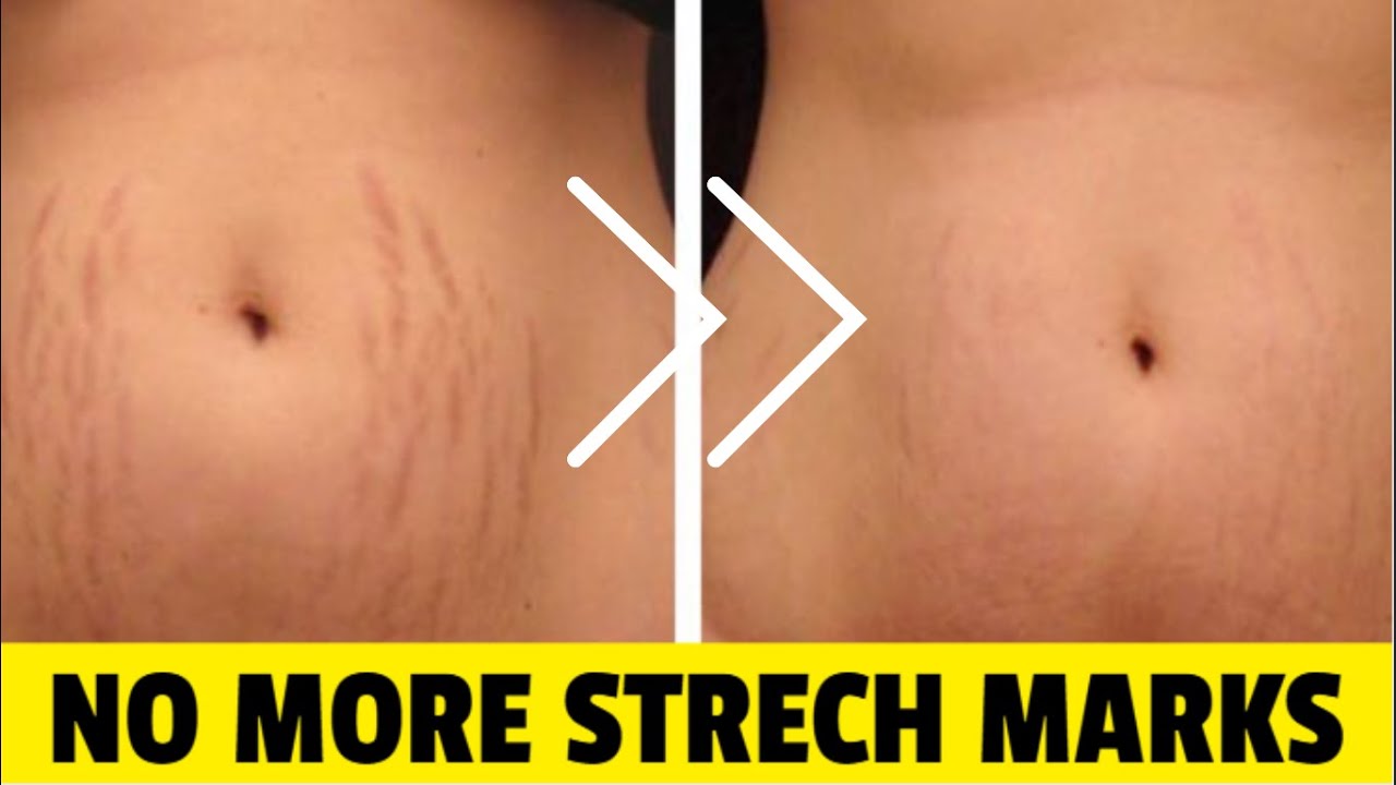 Home Remedies To Remove Stretch Marks Naturally - YouTube