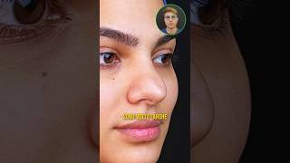 Wide tip 👃🏻 after rhinoplasty, solved with rhinofiller 💉#shorts