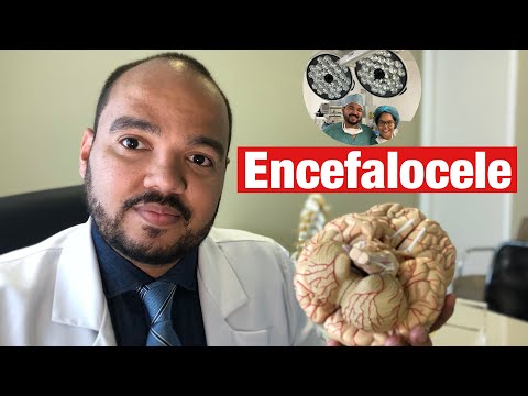 Encefalocele