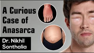 A Curious Case of Anasarca | Nikhil Sonthalia