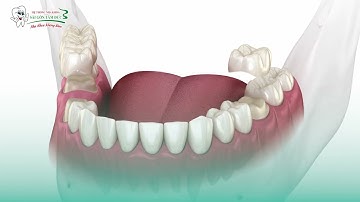 DỊCH VỤ CẦU RĂNG SỨ - NHA KHOA SÀI GÒN TÂM ĐỨC