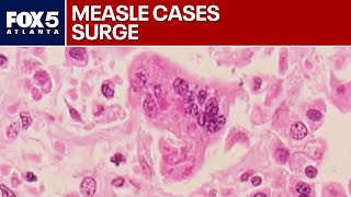 U.S. measles cases surge to highest | FOX 5 News