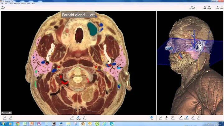 VHD PAROTID GLAND