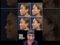 Finesse Rhinoplasty, 1 year post-op.