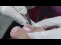 Ep_3709 Ingrown toenail removal 👣 เล็บจม..เป็นได้ยังไงครับ  😷 (clip from Thailand)