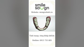 Phác đồ điều trị răng khấp khểnh - Smilesalign Việt Nam