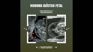 higroma quístico fetal.@consultdrjaider;  https://card.orbit900.com/dr.jaidergomezdiaz