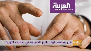 صباح العربية: اخسر وزنك بالإبر الصينية