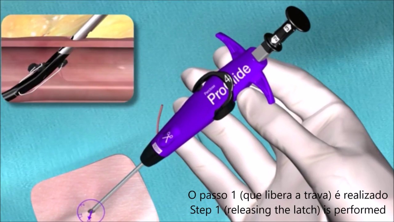 Principais Sistemas de fechamentos percutâneos para procedimentos endovasculares abdominal blockage
