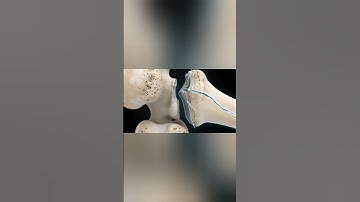Femur Fracture Explained in 3D