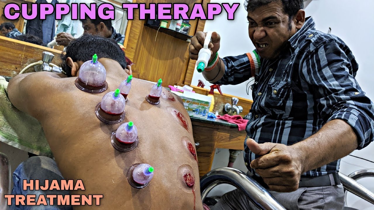 hijama pentru varicoza