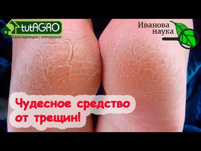 Трещины на пятках: почему возникают, и как устранить?