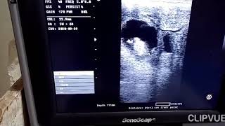 Calculation of fetal age by ultrasound screenshot 4