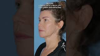 Before and After Facial Plastic Surgery #beforeandafter #plasticsurgery #facelift #co2laser