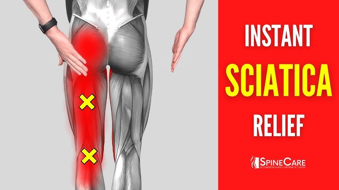 How to Relieve Sciatica Pain — Williamsburg Chiropractic