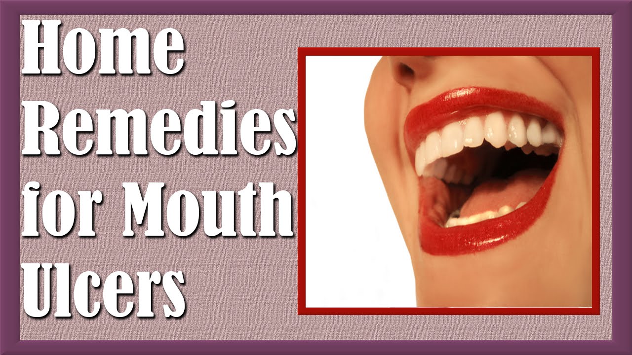 Natural Home Remedies for Mouth Ulcers YouTube