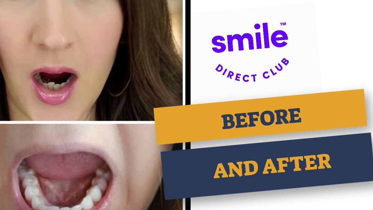 My Smile Direct Club Before and After | FINAL RESULTS | Was it worth it? -  YouTube