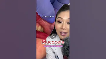 Here Is What A Blocked Salivary Duct Looks Like Mucocele Lip Dentist 
