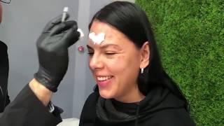 Aplicación De Toxina Botulinica Dr. Miguel Dominguez