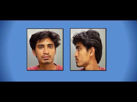 Complex Nose Reconstruction Using Patient's Own Rib Cartilage | Rhinoplasty By Dr. Debraj Shome