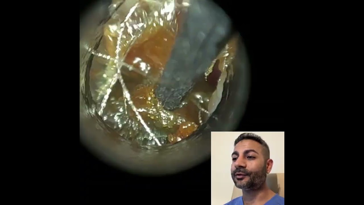 442 - Brave 3-Year-Old Has Severe Impacted Ear Wax Removed using the WAXscope®