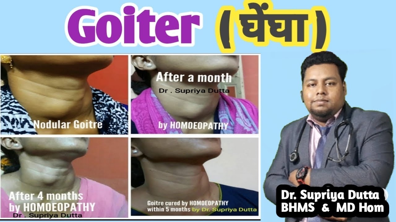 Goiter Homeopathic Treatment Without Surgeryin Hindiexplain By Dr