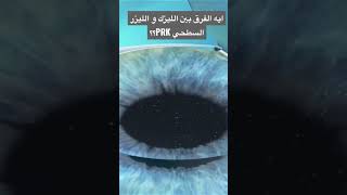 د. عبد الرحمن عطا الله | ايه الفرق بين الليزك و الليزر السطحي PRK؟؟