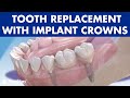 MISSING TEETH? Four solutions for TOOTH REPLACEMENT with IMPLANT CROWNS ©