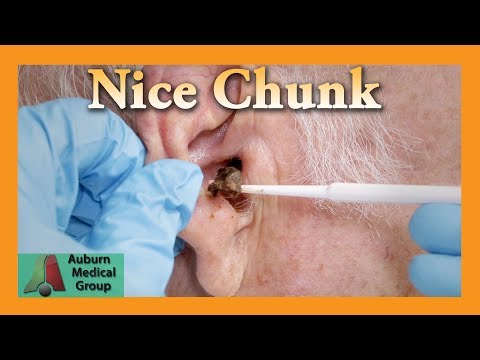 Chunk of Ear Wax Removal | Auburn Medical Group