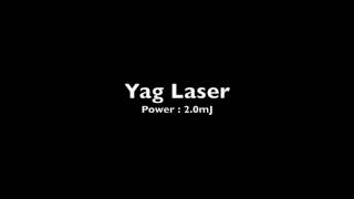Laser Peripheral Iridotomy - Argon followed by YAG - Normal speed
