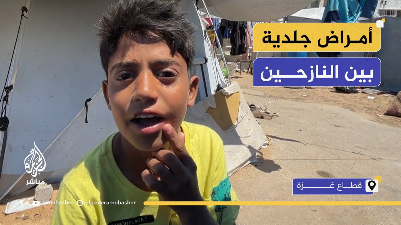 "من قلة الحموم".. أمراض جلدية وعطش دائم بسبب نقص المياه بغزة