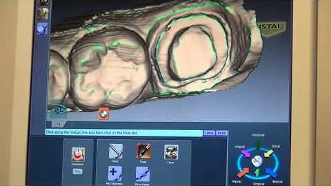 E4D Crown Milling Machine Demonstration (part 1 of 3)