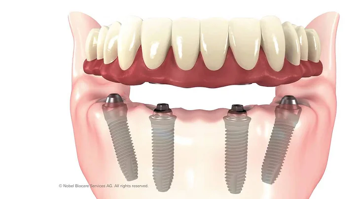 All On 4 Implant Procedure Animation