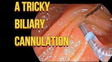 A Tricky Bile Duct Cannulation - #ERCP Skills