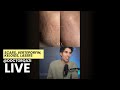 Dr. Qazi discusses Scars, Verteporfin, Keloids, Lasers | Dr. Qazi Unsponsored Live | 1.14.2025