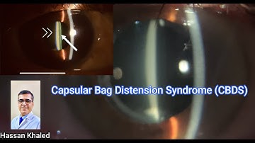 Capsular Bag Distension Syndrome (CBDS)