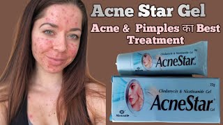 Acne Star Gel Remove | Acne | Pimples | Blackheads | Whiteheads | Complete Treatment In Hindi