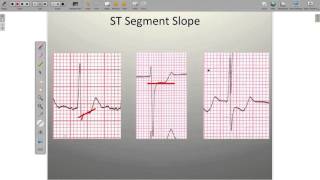 Effects of Ischemia on the ECG