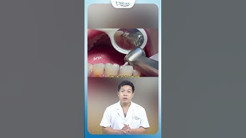 Sâu Kẽ Răng Cửa Có Làm Rụng Răng Không | Nha Khoa Minh Châu