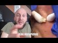 Pimple Poppers - By Julio Janpierre