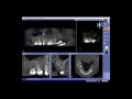 Reporting a Sirona CBCT Scan in Gallileos