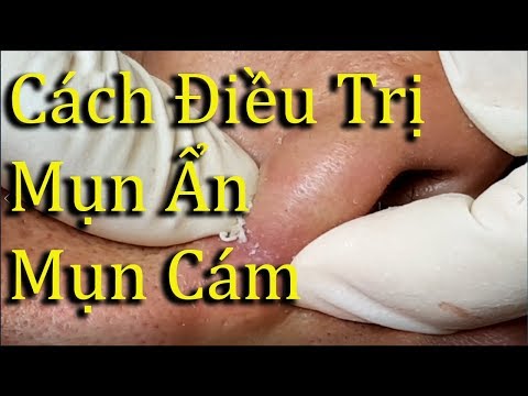 Cách điều trị mụn ẩn, mụn cám uy tín TPHCM. tại Hiền Vân Spa