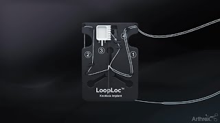 My Experience Using LoopLoc™ Knotless Implants