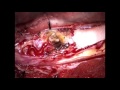 Spinal cord tumor HD