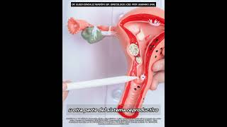Los quistes pueden erradicarse facilmente #embarazo #doctor